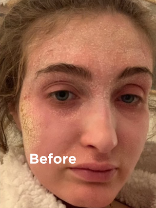 Face shot beefore using Sea Magik Eczema + Psoriasis Solutions