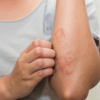 Eczema & Psoriasis Skin Care