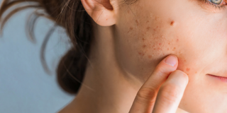 Top tips for managing teenage acne skin with sea minerals