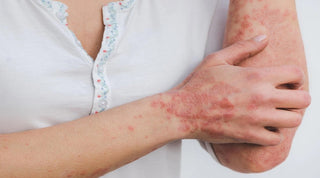 How does salt water help treat psoriasis and eczema?