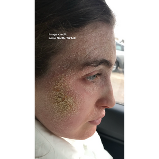 Topical Steroid Withdrawal (TSW)- Josie Before Picture 
