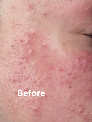 Acne Skin Solution