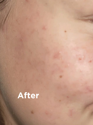 Acne Skin Solution