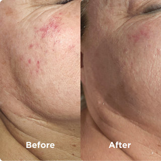 Before & After Algimud Mask