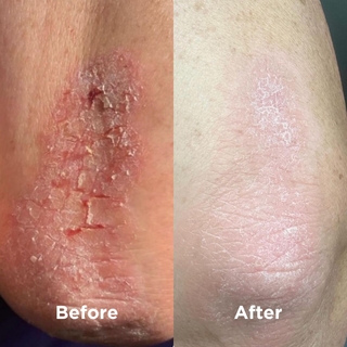 Before & After using Natural Skin Softener